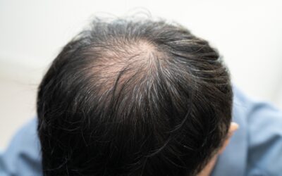Leczenie łysienia – trzy najczęstsze błędy w diagnozie trychologicznej